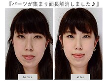 エピファニー(Epiphany)/30代　頬と顎のうにうにした感じ