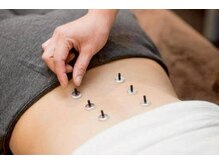 よつば鍼灸整骨院/お灸の施術