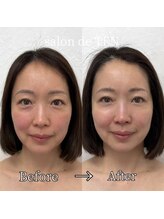 サロンド テン 広尾(salon de TEN)/広尾ハーブピーリング