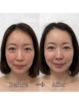 サロンド テン 広尾(salon de TEN)/広尾ハーブピーリング