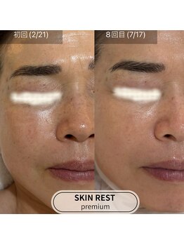 ロエン(Roen)/最高峰ヒト幹細胞100%原液導入