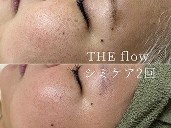 ザ フロウ(THE flow)/シミケア2回｜before/after