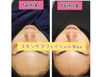 ハナ(HANA)/ワックス脱毛