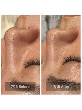 アヴニール 光の森(AVENIR)/毛穴洗浄☆１回の効果