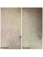 カピリナ(kapilina)/ニキビケアで背中も綺麗に