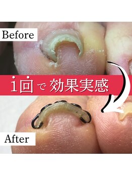 巻き爪矯正センター 沖縄 宜野湾/