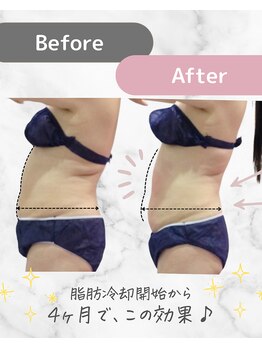 ミネット(minette)/脂肪冷却*before→after