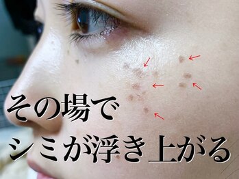 クルル(KROL)の写真/専門店ならではの感動シミ改善◎ピンポイントに素早く改善！直接アプローチ！隠す必要のない素肌へ。