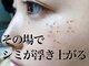 クルル(KROL)の写真/専門店ならではの感動シミ改善◎ピンポイントに素早く改善！直接アプローチ！隠す必要のない素肌へ。