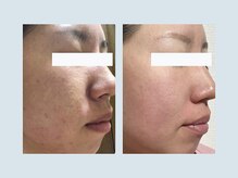 salon Uru.（サロン ウル）|毛穴・ニキビ・美肌専門の雰囲気（毛穴のざらつき、繰り返すニキビ悩み…プロケアで必ず変わります）