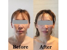 マルウル(maluulu)の雰囲気（ほうれい線が解消、頬ふっくら、ハリ艶小顔（40代／1回目））