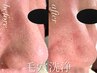 《毛穴洗浄》トルネード洗浄で黒ずみ,皮脂詰まりを一掃！