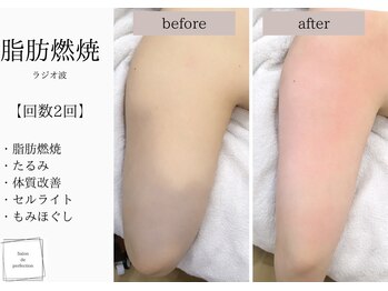 サロン ド パーフェクション(Salon de Perfection)/ラジオ波