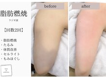 サロン ド パーフェクション(Salon de Perfection)/ラジオ波