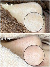 毛穴専科/古く固くなった頑固な角質も除去