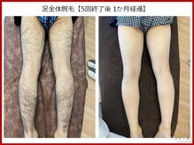 ひかり素肌/足全体脱毛（後面）