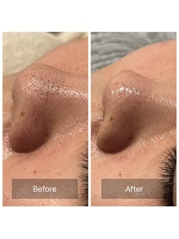 アヴニール 光の森(AVENIR)/毛穴洗浄☆１回の効果