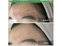 モカ 天王寺店(MOKA)/おでこニキビケア　シワケア