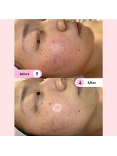 アネラ(ANELA)/赤み　ニキビケア