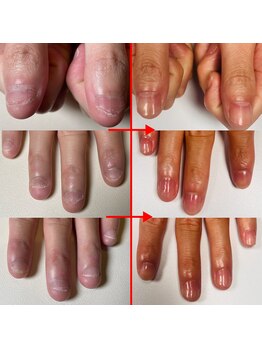 エルシャイン(L-shine)/深爪矯正