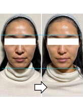 きしの美容整体院/フェイシャルリフトケアBA