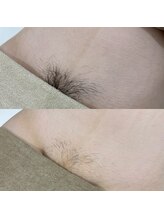 アウラ 表参道(AURA)/VIOワックス＋光脱毛