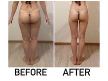 ヴィズクラブ バイ ビネル(Vi's CLUB by BINEL)/痩身before/after