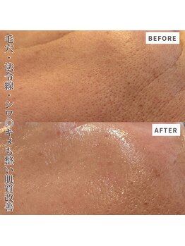 クラルテアンドコー(Salon Clarte&Co.)/韓国エステ版ポテンツァ#3回