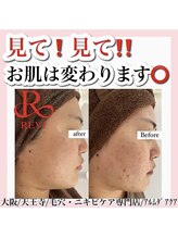 アルムダアクア 天王寺店(Aleumda AQUA)/大阪/天王寺/ハーブピーリング