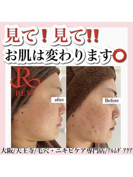 アルムダアクア 天王寺店(Aleumda AQUA)/大阪/天王寺/ハーブピーリング