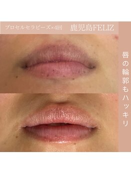 フェリス(FELIZ)/唇のぼやけた輪郭に