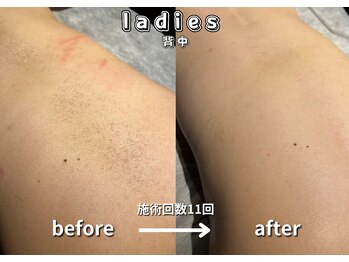 キュー(cue)/【レディース】「背中脱毛」