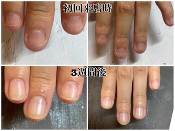 トラストネイル 佐野店(TRUST Nail)/深爪育成も大人気!