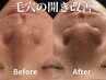 人気No1【毛穴の黒ずみ/毛穴開き】ハイドラスキン(毛穴洗浄) 90分