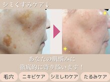ボンシェリの雰囲気（肌質改善お任せ下さい♪水光肌ピーリング￥6930）