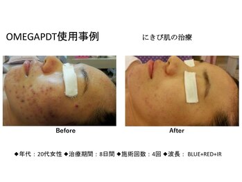 エミット(emit.)/LED光フェイシャル