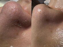 サラグランデ(Sara Grande)/黒ずみ角栓ごっそり！