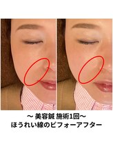 ララ鍼灸サロン(LaLa鍼灸サロン)/美容鍼のビフォーアフター