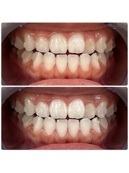 エクシアホワイトニング 日本橋店/矯正中