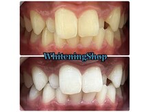 ホワイトニングショップ 津店/BeforeAfter