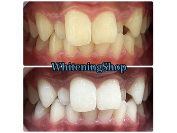 ホワイトニングショップ 津店/BeforeAfter