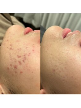ビープラス(BEE PLUS)の写真/《今話題の光美容》4,980から☆美肌×肌質改善・ニキビケアにも◎美容鍼との相乗効果で自分史上一番の肌へ!