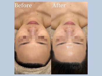 アイミーモア 国立店(aimer more)/陶肌トリートメントBef＆Aft