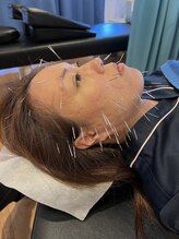 そるーな鍼灸院整体院/はりねずみ美容鍼でむくみ解消！