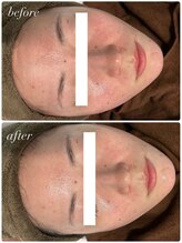 セローナ(Selona)/施術１回でこの変化！