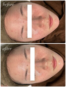 セローナ(Selona)/施術１回でこの変化！