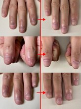 エルシャイン(L-shine)/深爪矯正