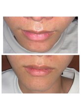 プルメリア(Plumeria)/スヴェイルスキンニキビ効果4