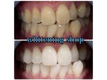 ホワイトニングショップ 津店/BeforeAfter