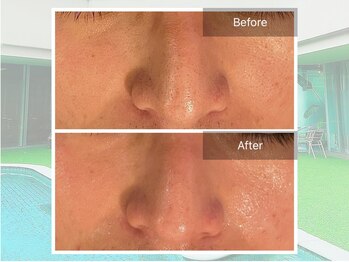 ベルゼ 渋谷店(BELZE)/メンズ毛穴洗浄♪